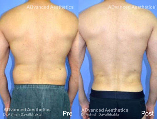 Case 5 : Vaser 4D liposuction : Back View