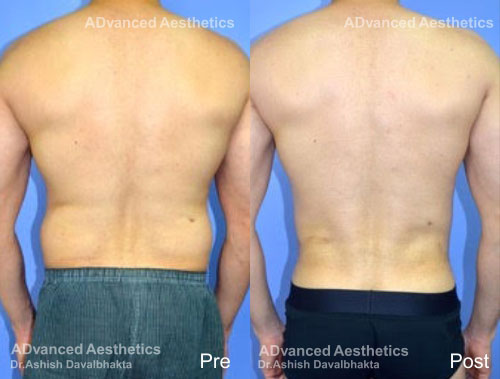 A Liposuction Procedure Promises 6-Pack Abs Without Lifting a Finger