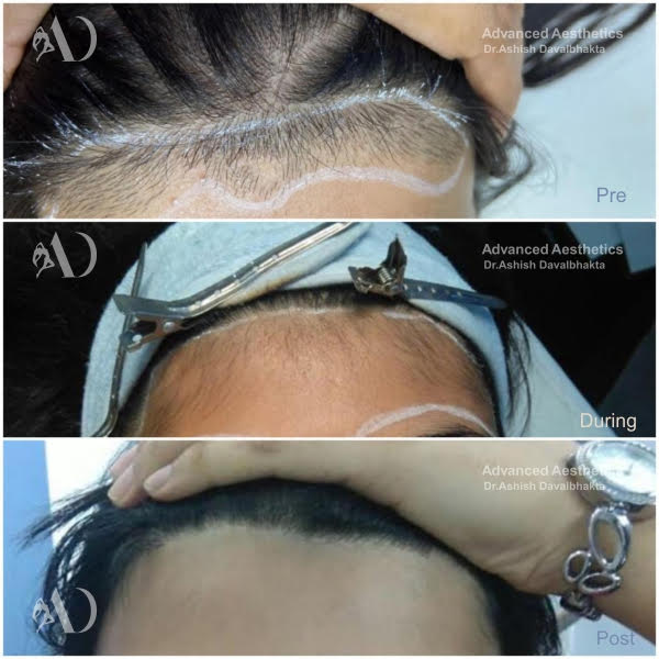 laser hair reduction before-after