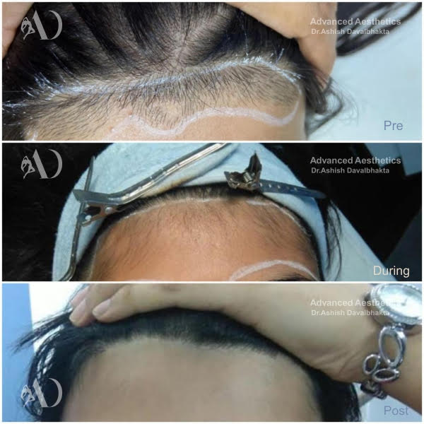 Before and After Results of Laser Hair Reduction at Aesthetics Medispa, Pune.