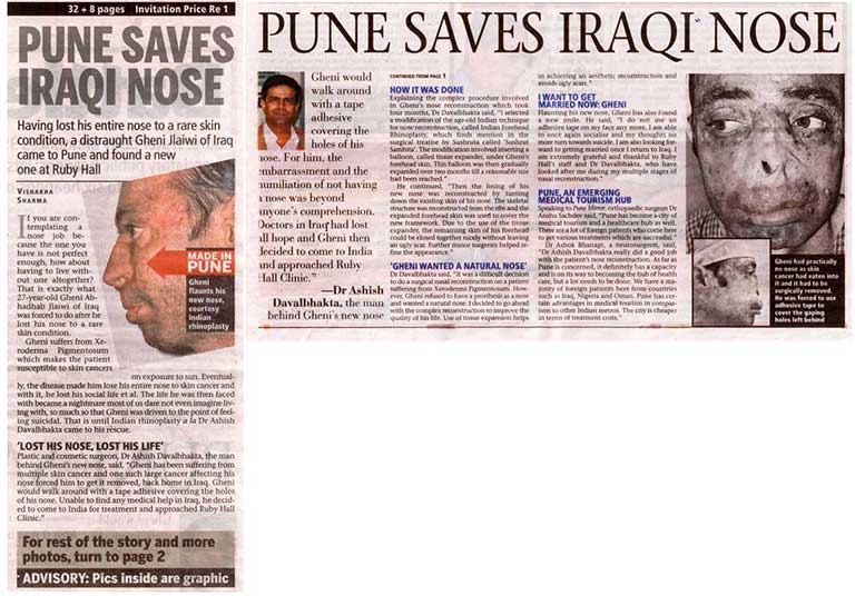 Pune saves Iraqi nose