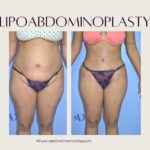 Lipoabdominoplasty case 11 front view