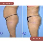 Lipoabdominoplasty case11 side view