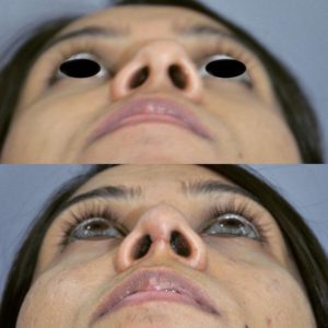 Rhinoplasty before-after basal view