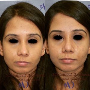 Rhinoplasty before-after front view