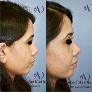 Rhinoplasty before-after side view