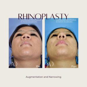 Case 21 : Rhinoplasty : Basal View