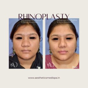 Case 21 : Rhinoplasty : Front View