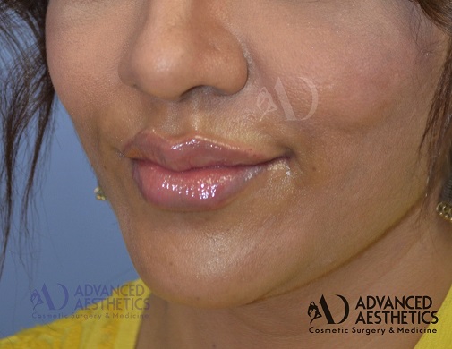 Lip Augmentation with fillers at aesthetic medispa in pune. (after)