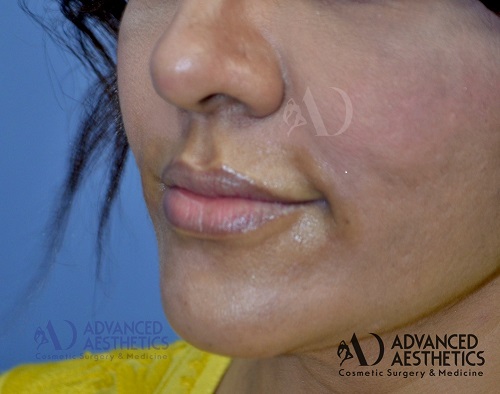 Lip Augmentation with fillers at aesthetic medispa in pune. (before)