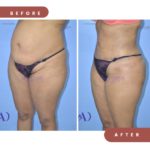 lipoabdominoplasty case 11