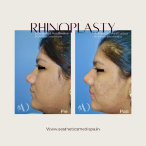 Case 21 : Rhinoplasty : Side View