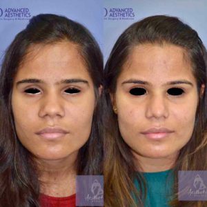 Case 20 : Broad nose bulbous tip & wide nostril correction : Front View