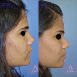 Case 20 : Broad nose bulbous tip & wide nostril correction : Side View