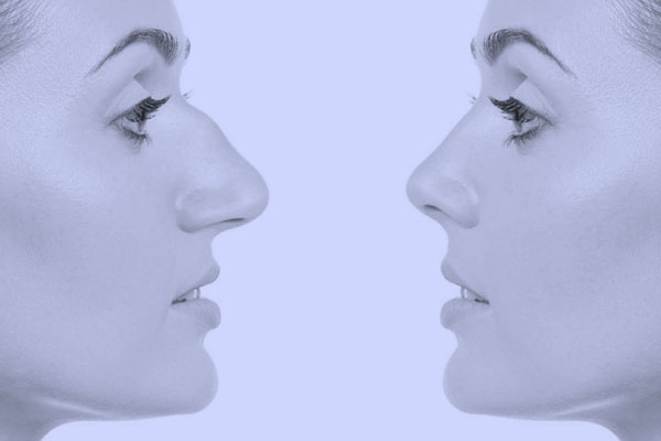 rhinoplasty