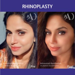 Case 23 : Rhinoplasty : Post-traumatic fracture nose correction