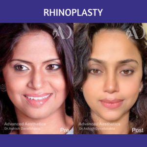 Case 24 : Rhinoplasty : Post-traumatic fracture nose correction
