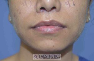 Lip Reduction (lift) at Aessthetic medispa in Pune by Dr. . Ashish Davalbhakta (After)