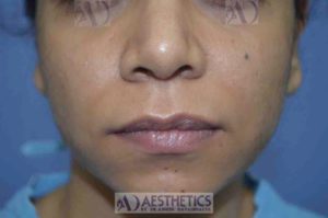 Lip Reduction (lift) at Aessthetic medispa in Pune by Dr. . Ashish Davalbhakta (Before)