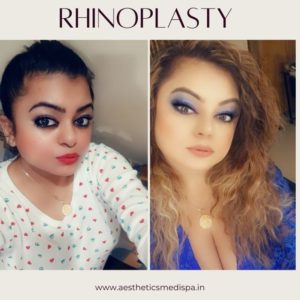 Case 27 : Rhinoplasty : Nose Reshaping : Front View