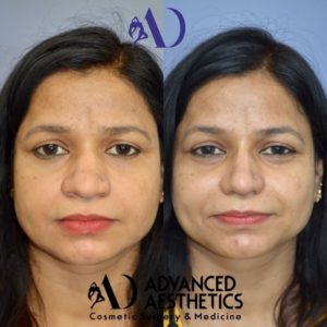 Augmentation and narrowing rhinoplasty : Front View