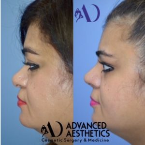 Case 27 : Rhinoplasty : Nose Reshaping : Side View