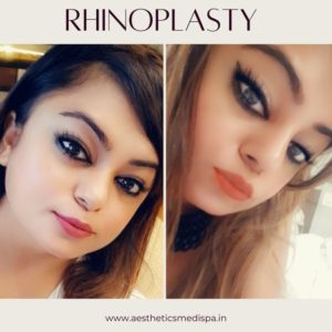 Case 27 : Rhinoplasty : Nose Reshaping : Front View