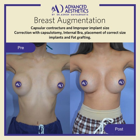 Case 9 : Correction of Post Breast Augmentation Complications
