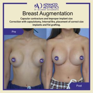 Case 9 : Correction of Post Breast Augmentation Complications.