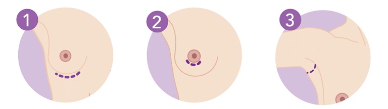 breast-incision