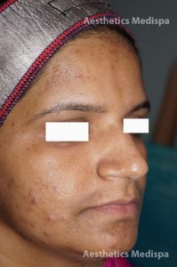 Acne case 5: right view (after)