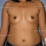 Case 2 : Breast Augmentation : Grade 0 ptosis, double A cup