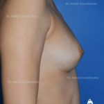 Case 4 : Breast Augmentation : Side View (Before)