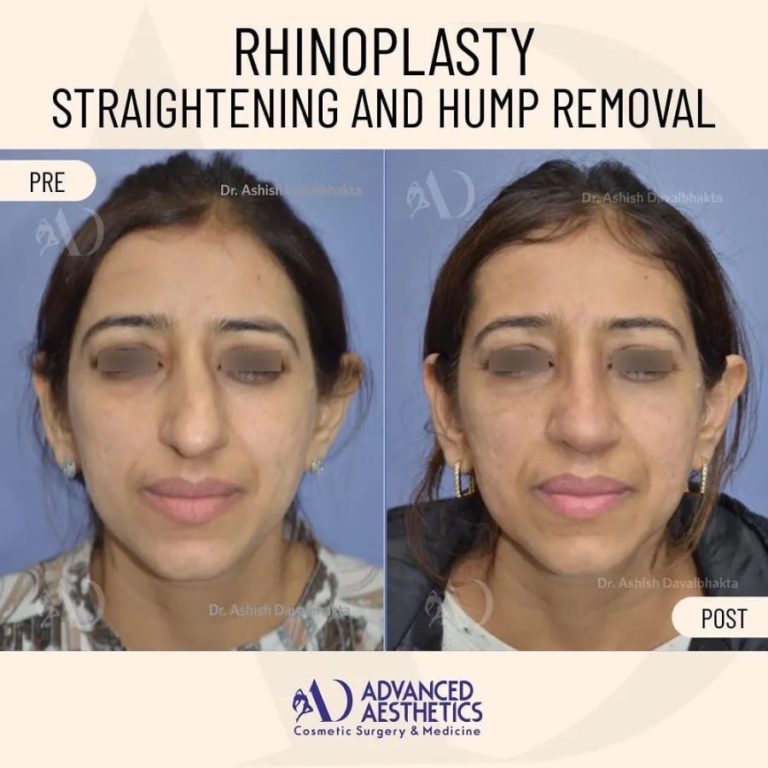 Rhinoplasty case study front view