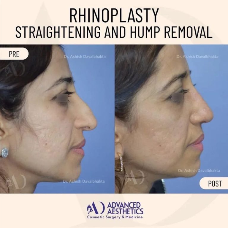 Rhinoplasty case study side view