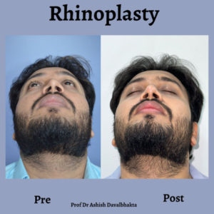 Rhinnoplasty-twisted-nose-surgery-by-dr-ashish-davalbhakta-02