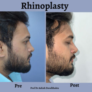 Rhinnoplasty-twisted-nose-surgery-by-dr-ashish-davalbhakta-03