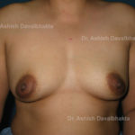 Case 1 : Breast Augmentation with fat grafting: Front View (before)