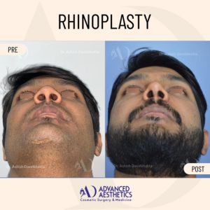 Septoplasty-before-after-1