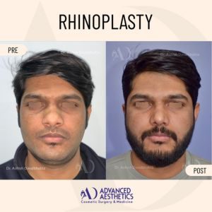 Septoplasty-before-after-2