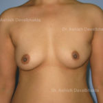 Case 2 : Breast Augmentation with fat grafting: Front View (Before)