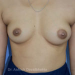 Case 3 : Breast Augmentation with fat grafting: Front View (Before)