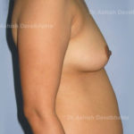 Case 2 : Breast Augmentation with fat grafting: Side View (Before)