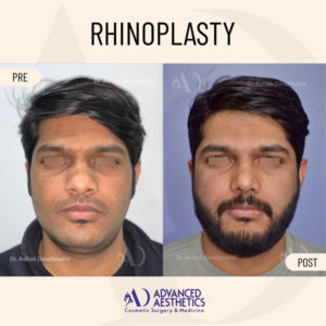 rhinoplasty-front-view-before-after-by-dr-ashish-davalbhakta-28