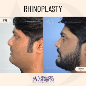 rhinoplasty-bottom-view-before-after-by-dr-ashish-davalbhakta-28