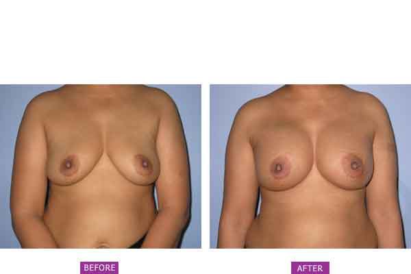 Case 7 : Breast Augmentation : Front view