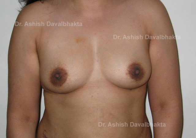 Case 1 : Breast Augmentation with fat grafting: Front View (After)