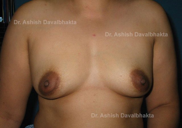 Case 1 : Breast Augmentation with fat grafting: Front View (before)