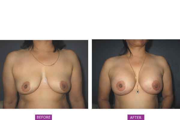 breast-augmentation-case-6
