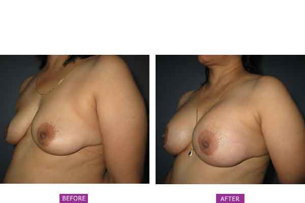 Case 6: Breast Augmentation : Post Pregnancy Deflation and Grade 2 Sagging : Side View